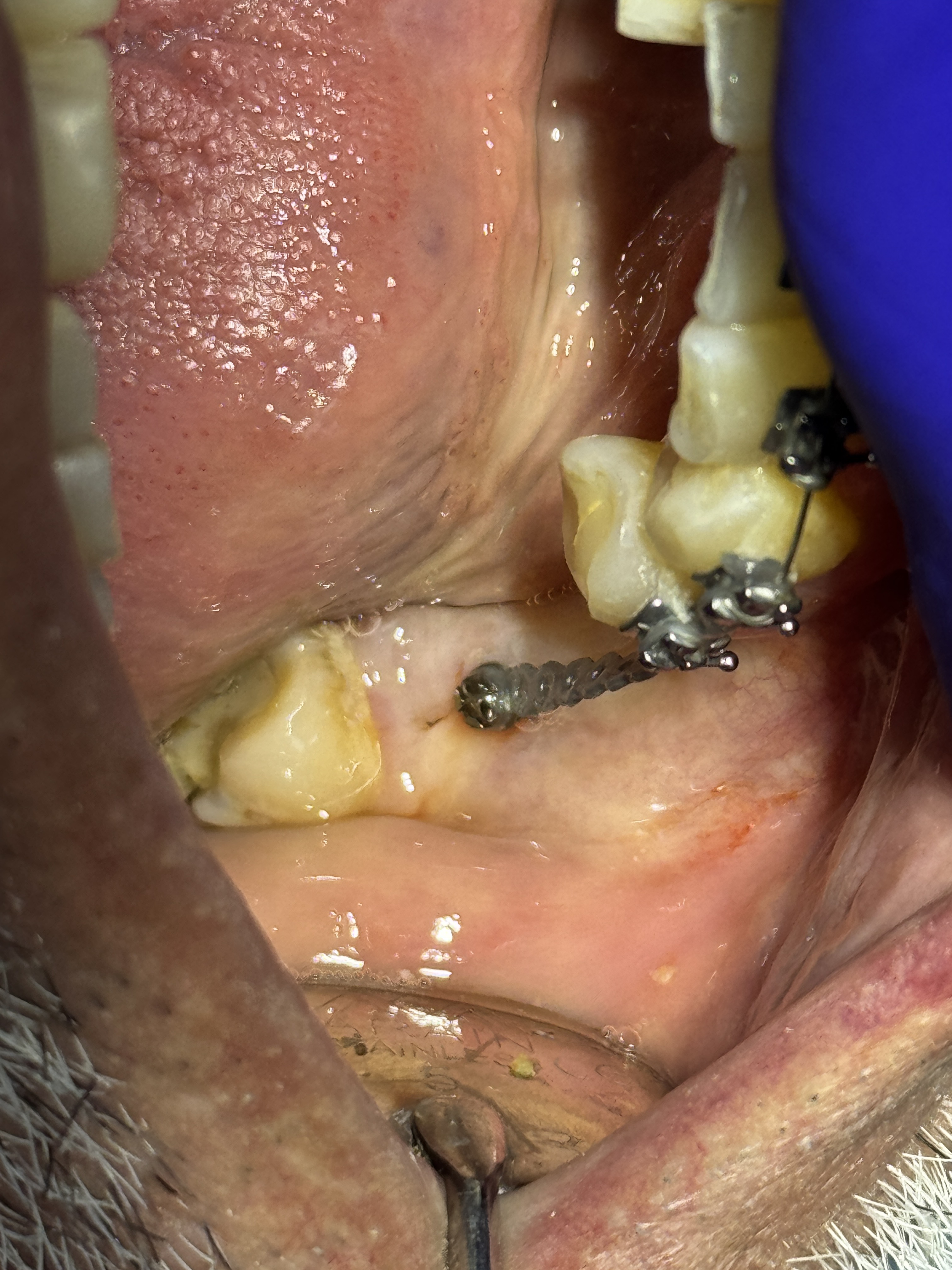 Microtornillo ortodóncico